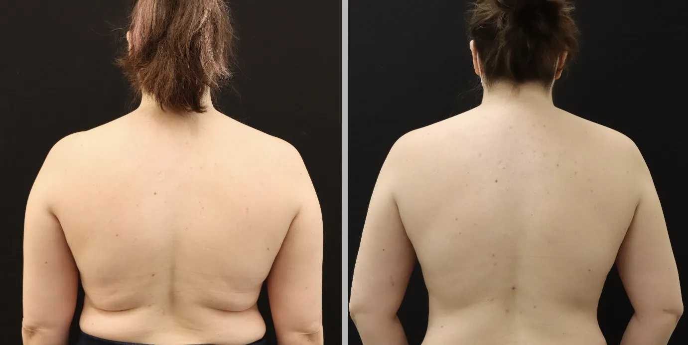 Evolve Body Contouring Results